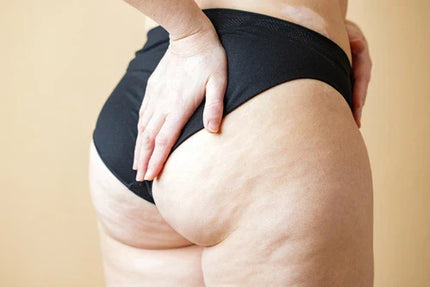 Jak rozpoznać i zwalczyć cellulit wodny?